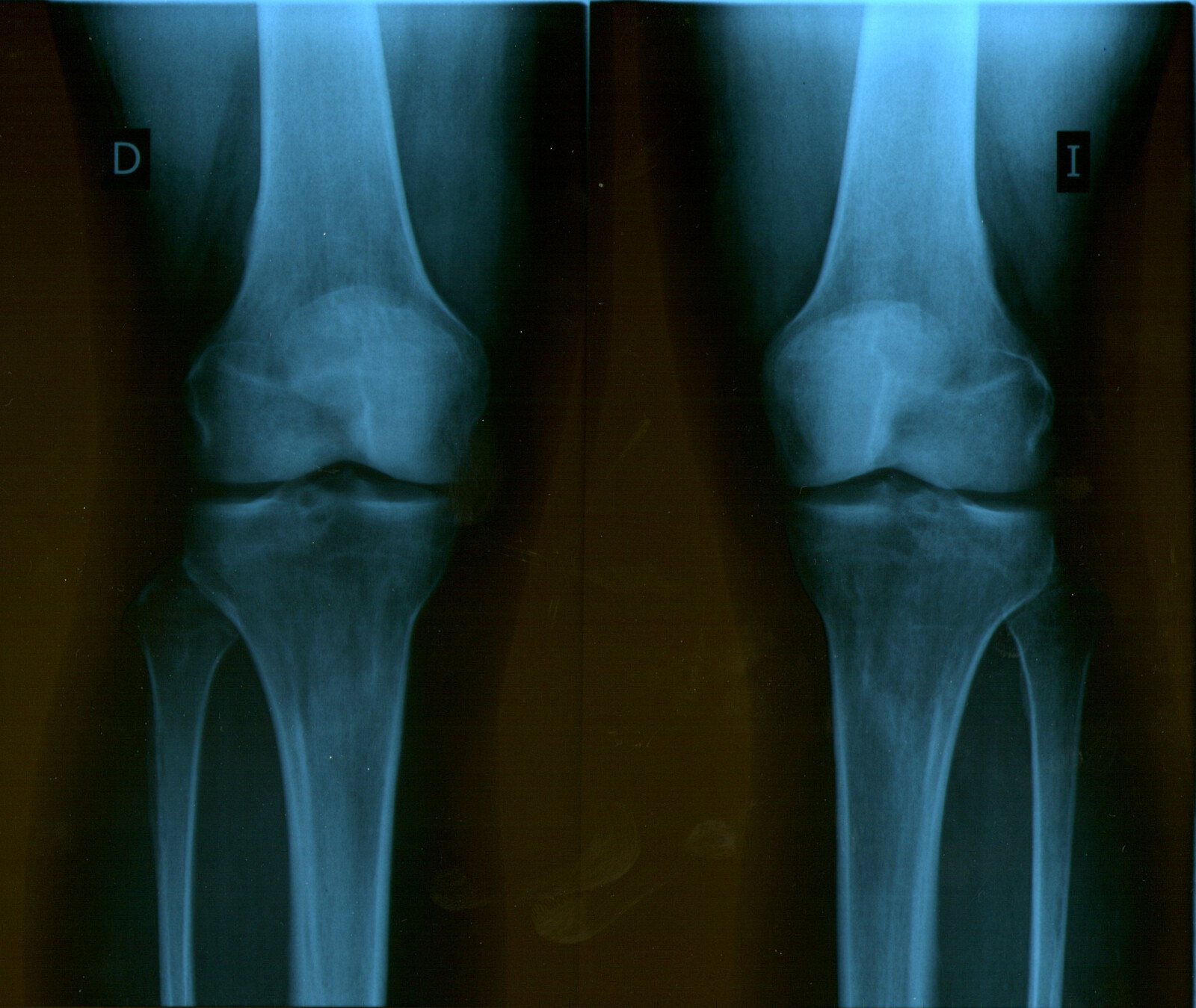 Orthopedic Injuries: Your Path to Compensation
