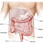 crohn’s disease